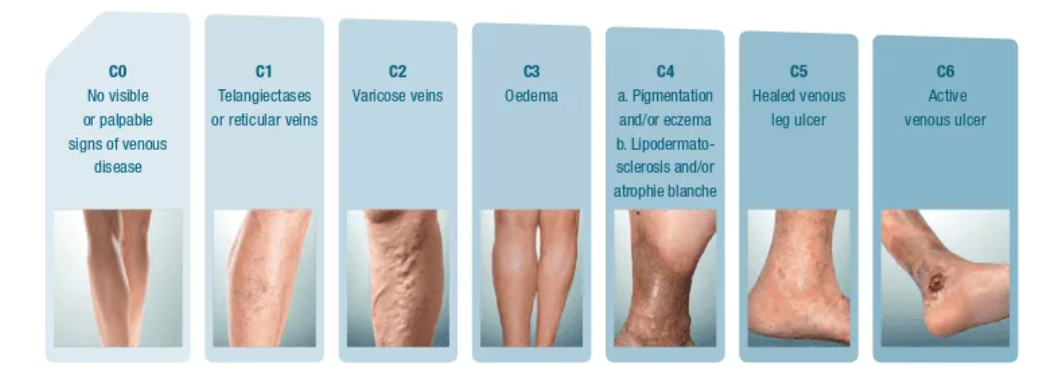 Chronic Venous Insufficiency: Causes, Diagnosis and Treatment